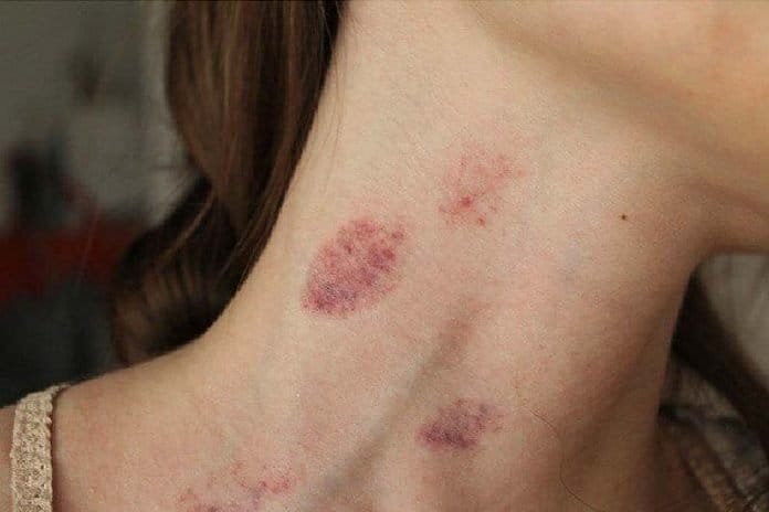 How To Get Rid Of A Hickey Fast