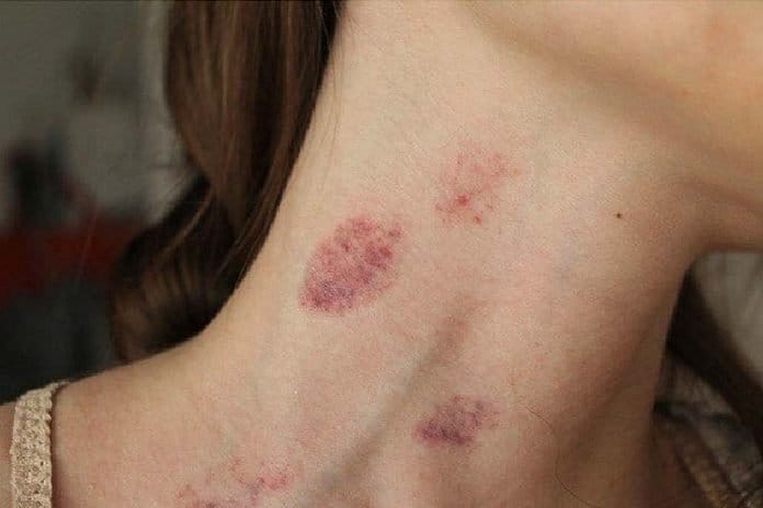 Hickey How To Get Rid Of A Hickey Fast