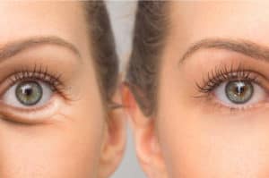 How to Get Rid of Under Eye Bags With Surgery
