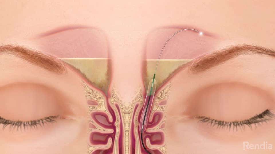 Sinuplasty procedure Sinuplasty