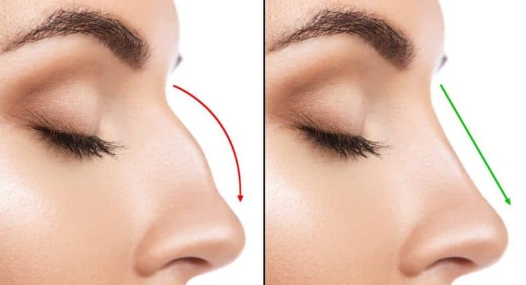 Revision Rhinoplasty for Perfect Nose Surgery Correction