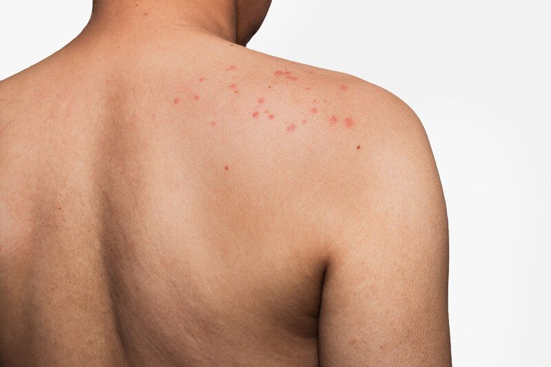 Current Skin Allergy 5 Causes of Tattoo Pimples and How To Get Rid Of Them5 Causes of Tattoo Pimples and How To Get Rid Of Them