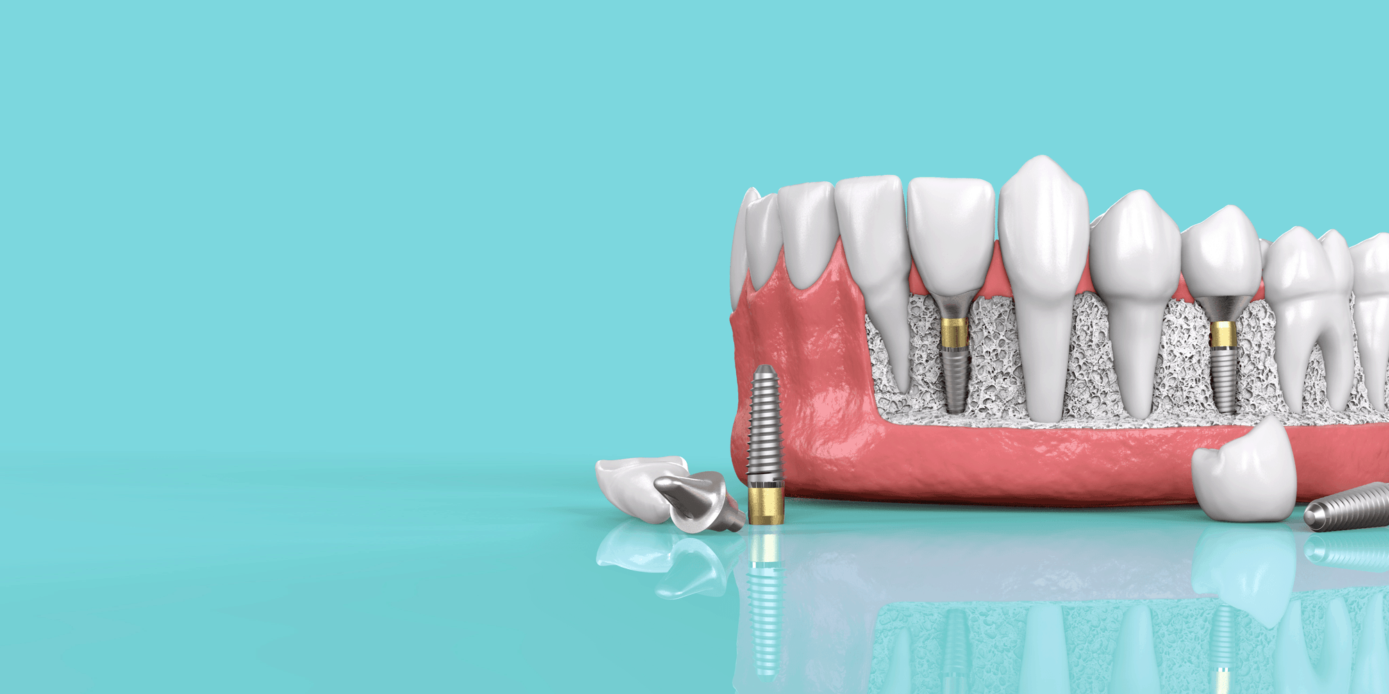 Top 3 Reasons Dental Implants are Increasingly Becoming Popular