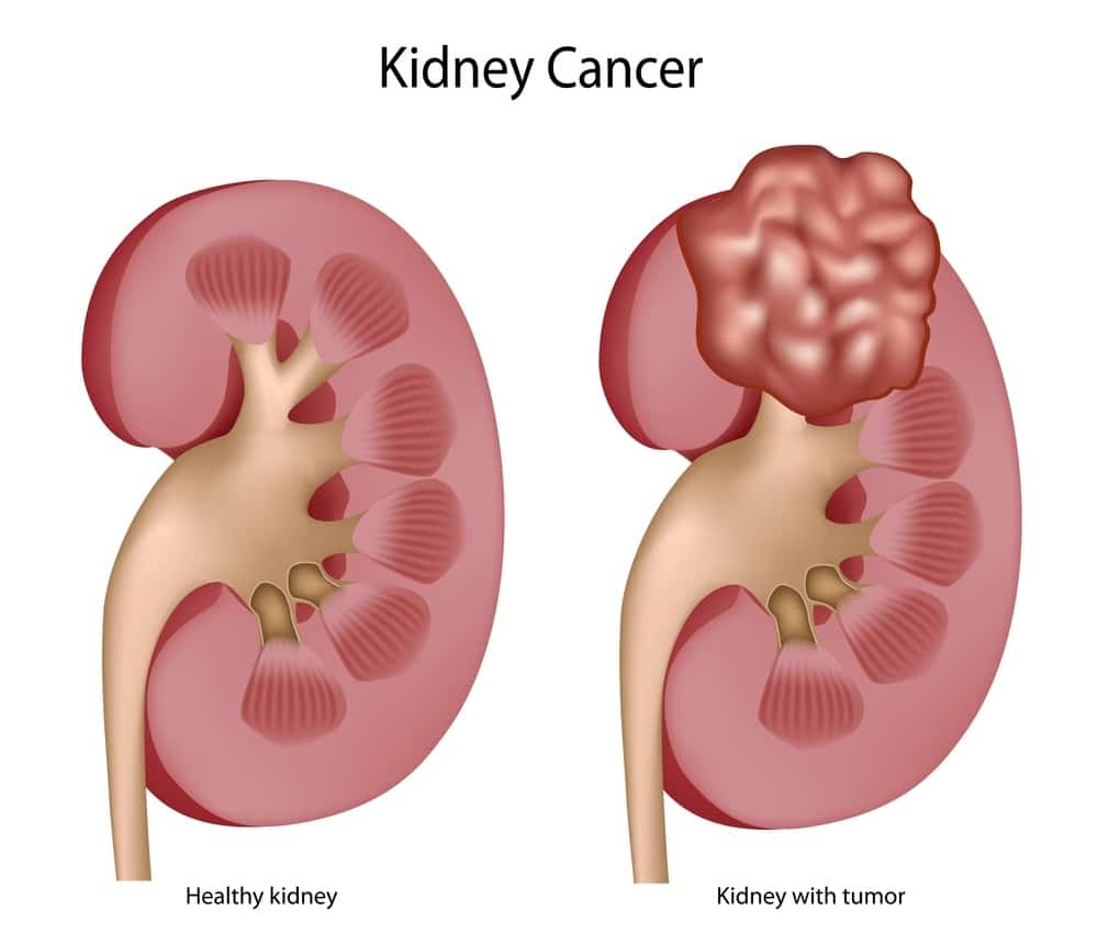 About Kidney Cancer