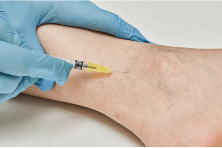 varicose veins treatment