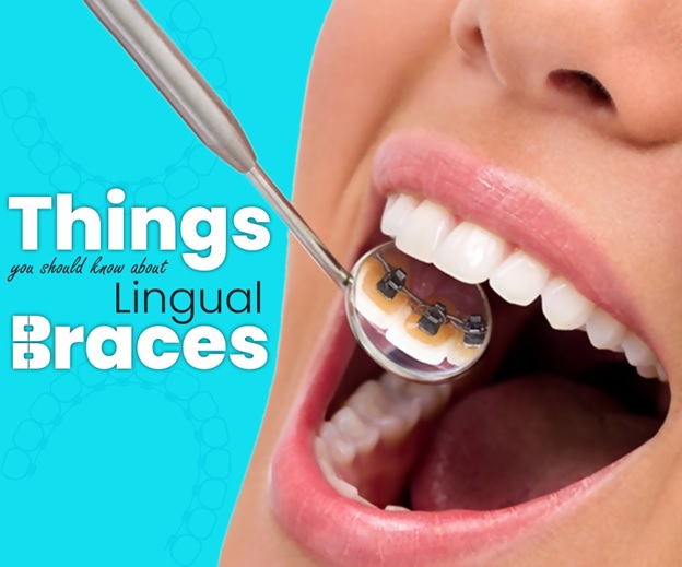 Lingual braces