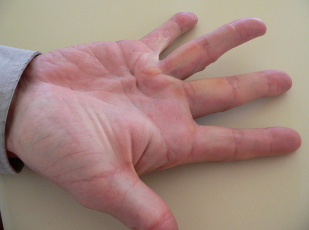 Dupuytren’s contracture